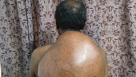 ट्यूमर