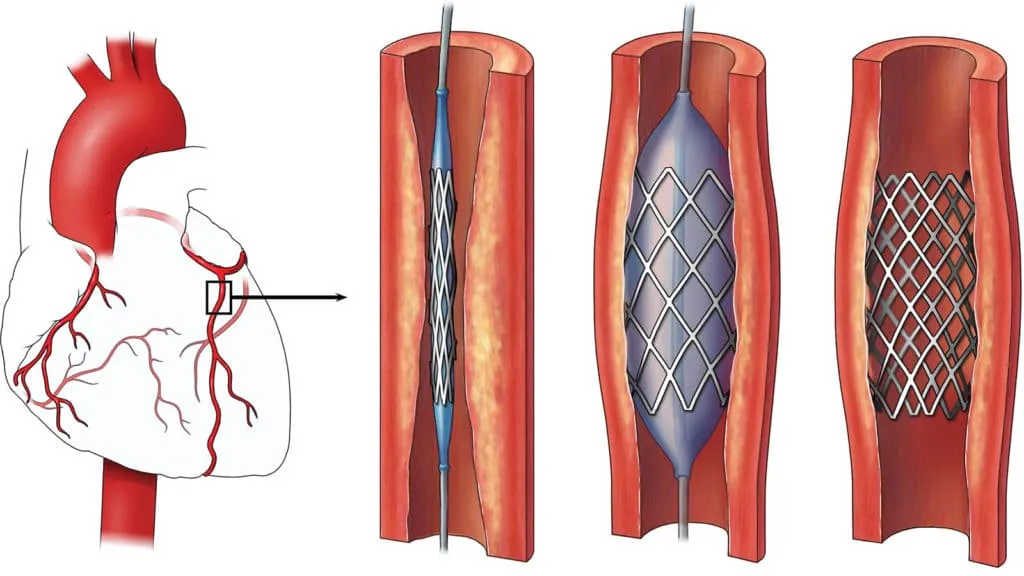 Stents