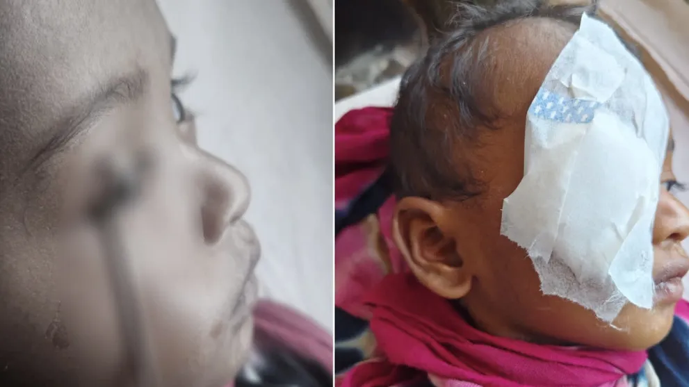 Doctors successfully remove tongue cleaner from child’s eyelid