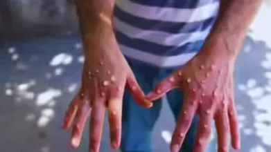 monkey pox