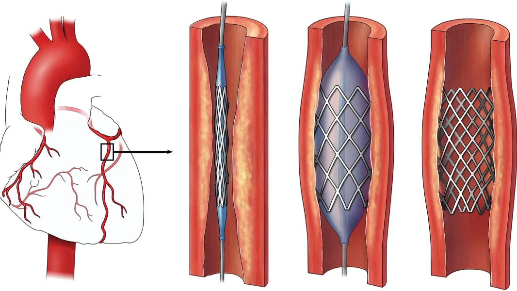 cardic-stent